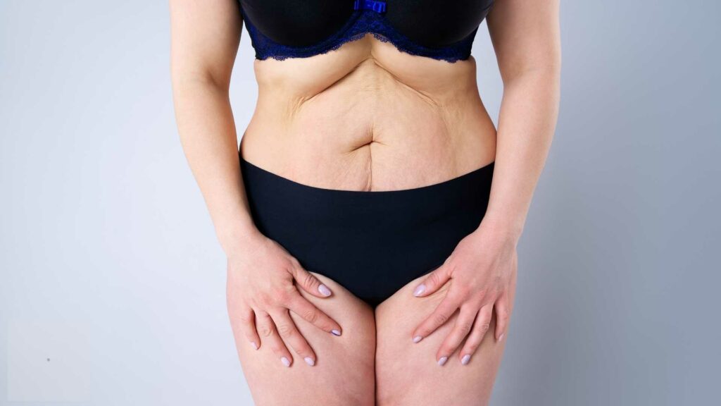 Is a Tummy Tuck Good for You