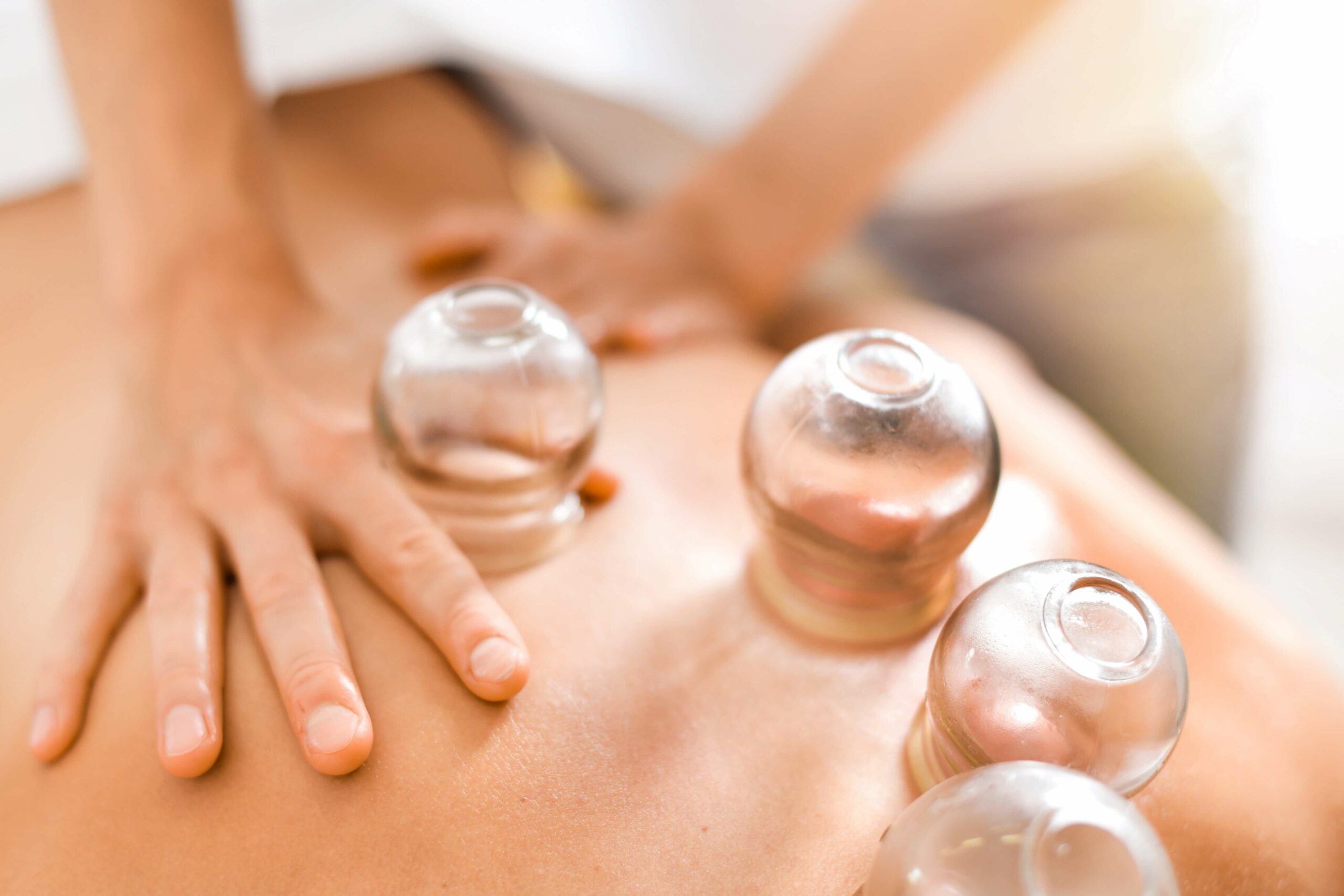 Cupping Therapy