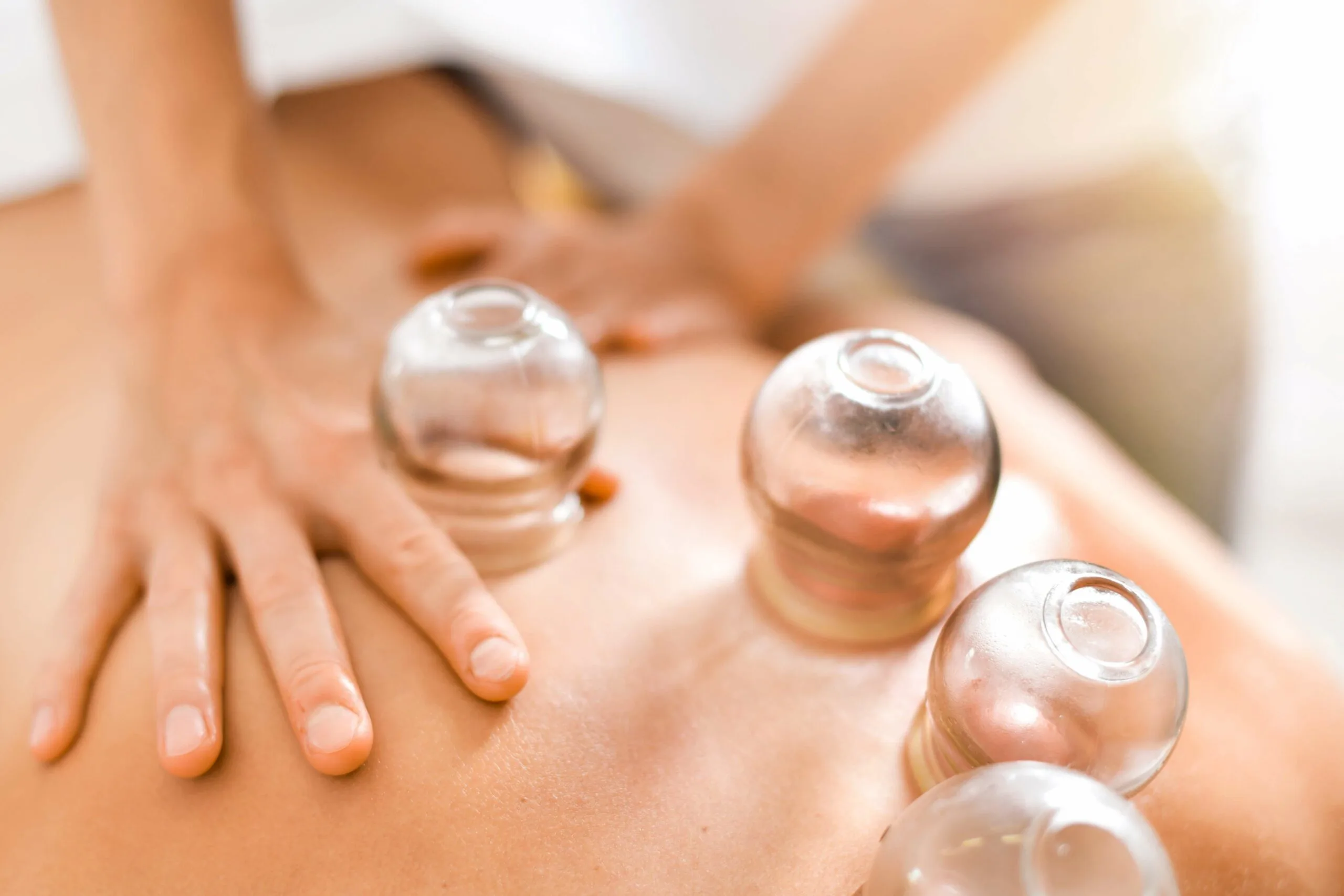 Cupping Therapy