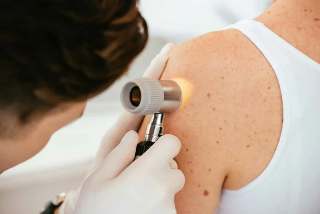 skin cancer treatment