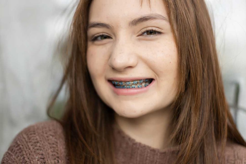 Benefits of Braces