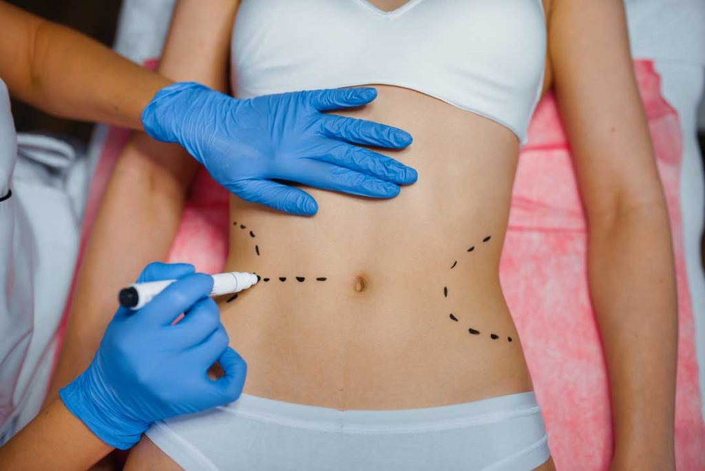 Tummy tuck qualifications