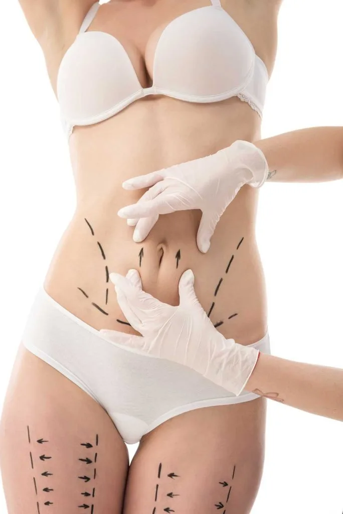 Tummy tuck requirements